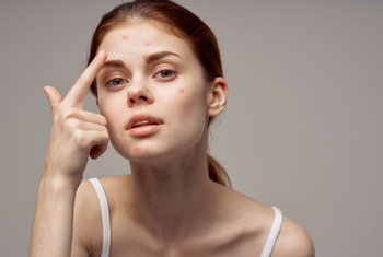Understanding the Causes of Acne and How to Address Them Naturally
